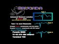 brugada ecg to diagnosis