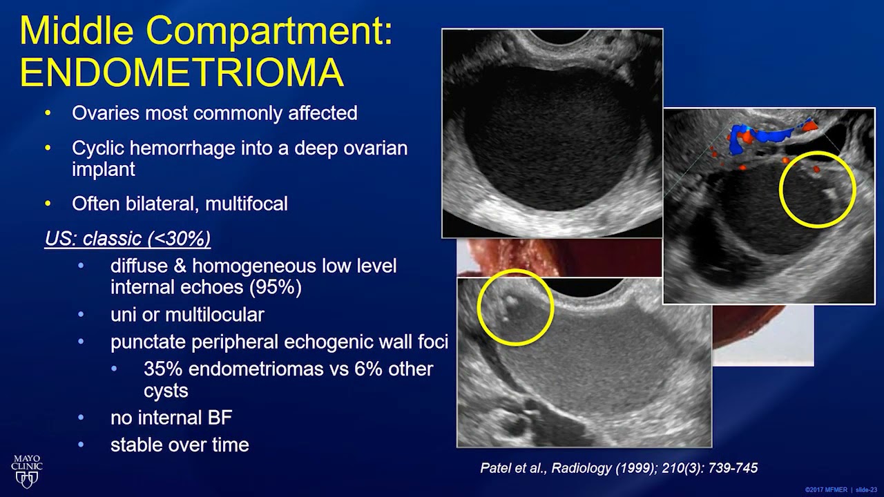 Endometrioma Ultrasound