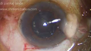 #93 Manual Small Incision Cataract Surgery- DR PL