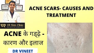 मुँहासो के गड्ढ़े - कारण और इलाज| Acne scars- Causes & Treatment| VR Skin Clinic| Dr Vineet| Bikaner