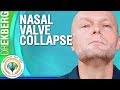 Collapsed Nasal Passage / Nasal Valve Collapse