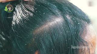 She scratch dandruff look so interested 2185