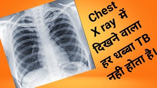 Chest X ray me bimari|सिने के एक्स रे मे बीमारी|