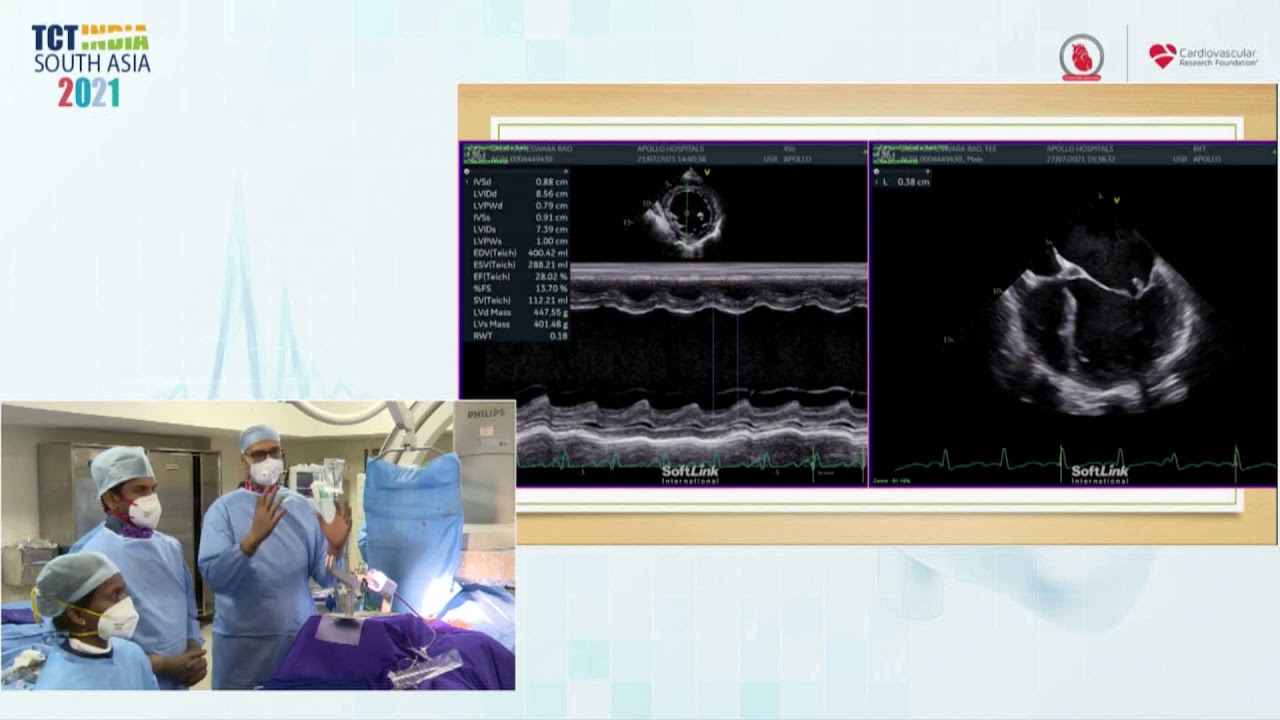 Live Case Percutaneous Closure Of Severe Mr In Severe Lv Dysfunction