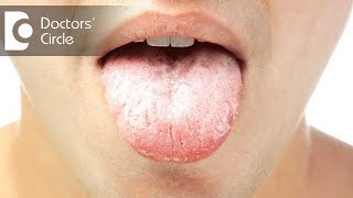 What is the frequency of anti fungal medications for Oral Thrush? - Dr. Jayaprakash Ittigi