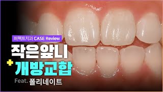 작은 앞니\u0026개방교합 마취없이 무삭제폴리네이트✨| 0.1mm 최소삭제 CASE