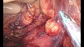 Hand Access Laparoscopic Right Colectomy featuring the GelPort Laparoscopic System