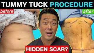 Watch This Tummy Tuck with a HIDDEN SCAR?