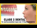 👉Maloclusion dental - 𝙈𝙤𝙧𝙙𝙞𝙙𝙖 𝘾𝙡𝙖𝙨𝙚 𝙄𝙄  dental en Ortodoncia - que es y como corregirla