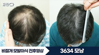 3634모낭 대량이식 정수리 체모이식 #자라다의원 #턱수염이식