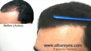 Hair transplant with Dr. Alba Reyes. Results after 9 months