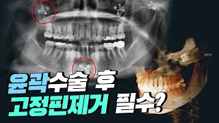 윤곽수술 후 고정핀제거 필수일까?