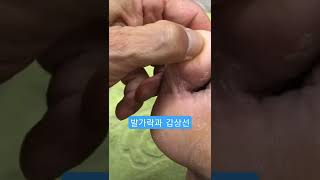 발가락과 갑상선