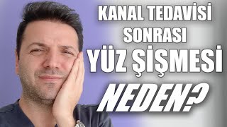 Kanal Tedavisi Sonrasında Neden Yüz Şişer? Kanal Tedavisi Sonrasında Ağrı Olur mu? Nasıl Yapılır?