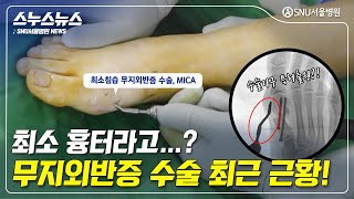 [스누스뉴스] 최소 흉터와 최소 통증으로 회복이 빠르다고...? 무지외반증 수술 최근 근황★ │#SNU서울병원 #족부전담팀 #MICA #최소침습무지외반증수술