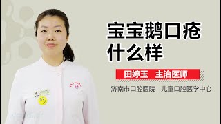 宝宝鹅口疮什么样 有来医生