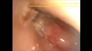 外耳炎 耳道狹窄 肉芽腫 AOE stenosis granuloma  劉耿僚醫師