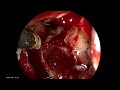 Hemostasis in Endoscopic Transphenoidal Excision of Pituitary Microadenoma