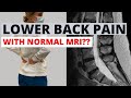 Why Is Your Back MRI Normal? | How To Really Know Cause Of Pain!