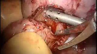 Laparoscopic Hand-Assisted Partial Nephrectomy