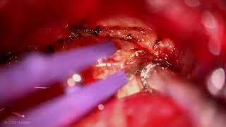 Extended Retrosigmoid Craniotomy for Resection of a Vestibular Schwannoma