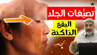 التخلص من تصبغات البشرة و البقع الداكنة || افهم السبب