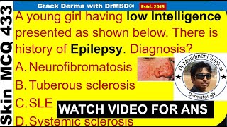 Tuberous sclerosis | Vogts Triad | EpiLoiA | Adenoma sebaceum | Koenens tumours | Ash Leaf Macules |