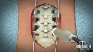Lumbar Discectomy Surgery: Medical Animation