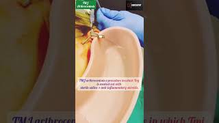 TMJ Arthrocentesis | Arthrocentesis treatment of Chronic TMJ Pain 💉💉 #shorts #dentist #viral 🔥🔥