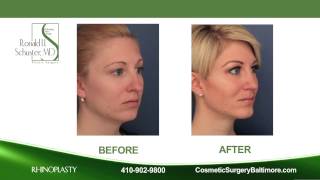 Rhinoplasty by Dr. Schuster