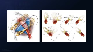 Thrombotic, Dolichoectatic, Distal PCA Aneurysm Treated with Excision and P2-P2 Reanastomosis