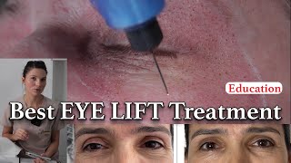 Plasma Pen Eye Lift best lifting technique - before and after photos (2025)