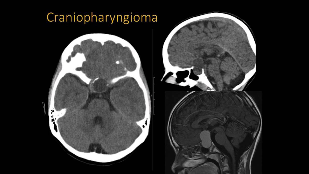 Radiological Characteristics Hypothalamic Hamartomas Dr Marcia