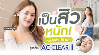 AC Clear | เป็นสิวหนัก จนไม่กล้าโชว์ผิวรักษาด้วยโปรแกรม AC CLEAR II | รักษาสิว