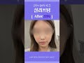 shorts 30대 여자 실리프팅 비포애프터 민트실 캐번실 블루다이아