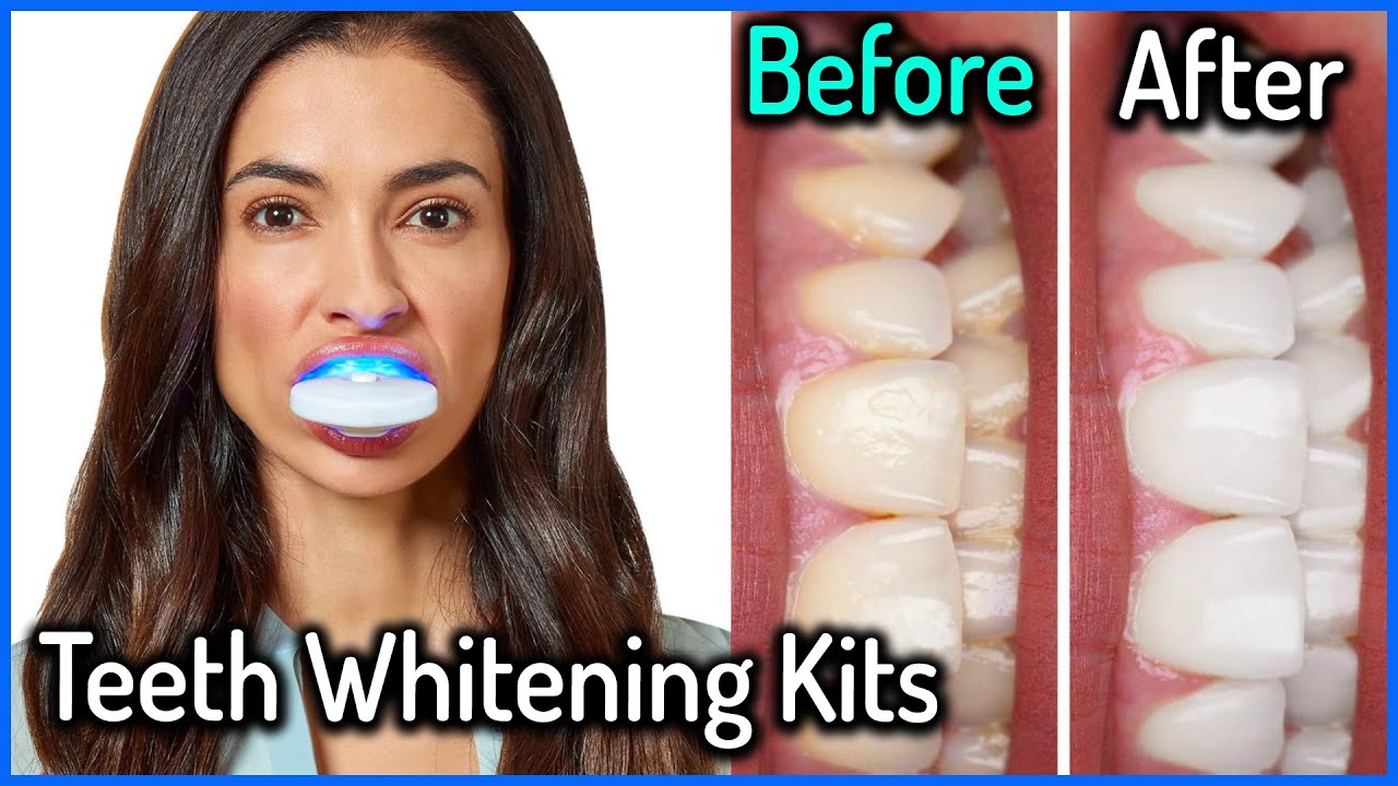 Top 5 Best Teeth Whitening Kits Reviews Of 2020 - YouTube