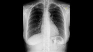 RADS.102 Density/IR Exposure
